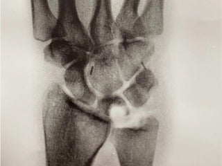 An x ray of professional rock climber and photographer Savannah Cummins broken bone.