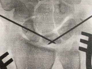 An x ray showing the pins in professional rock climber and photographer Savannah Cummins' bone.